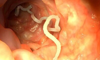 příčiny parazitů v lidském těle